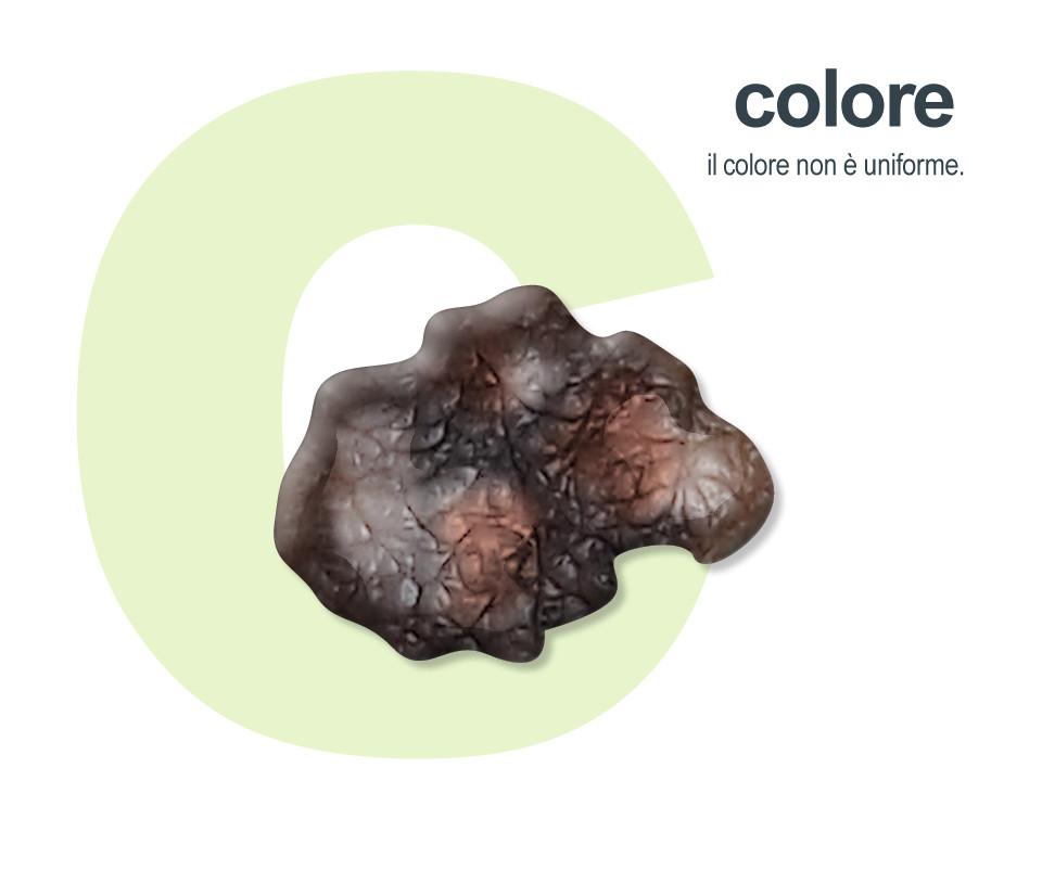 Riconoscere melanoma: Colore