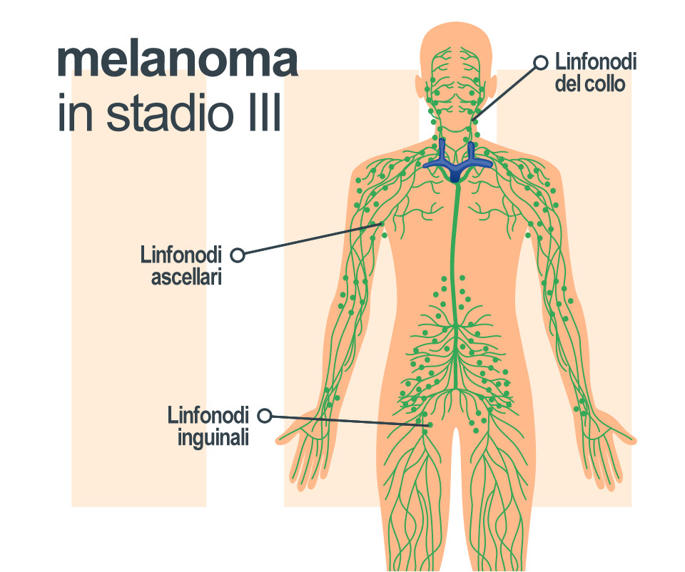 Evoluzione: Melanoma in stadio III
