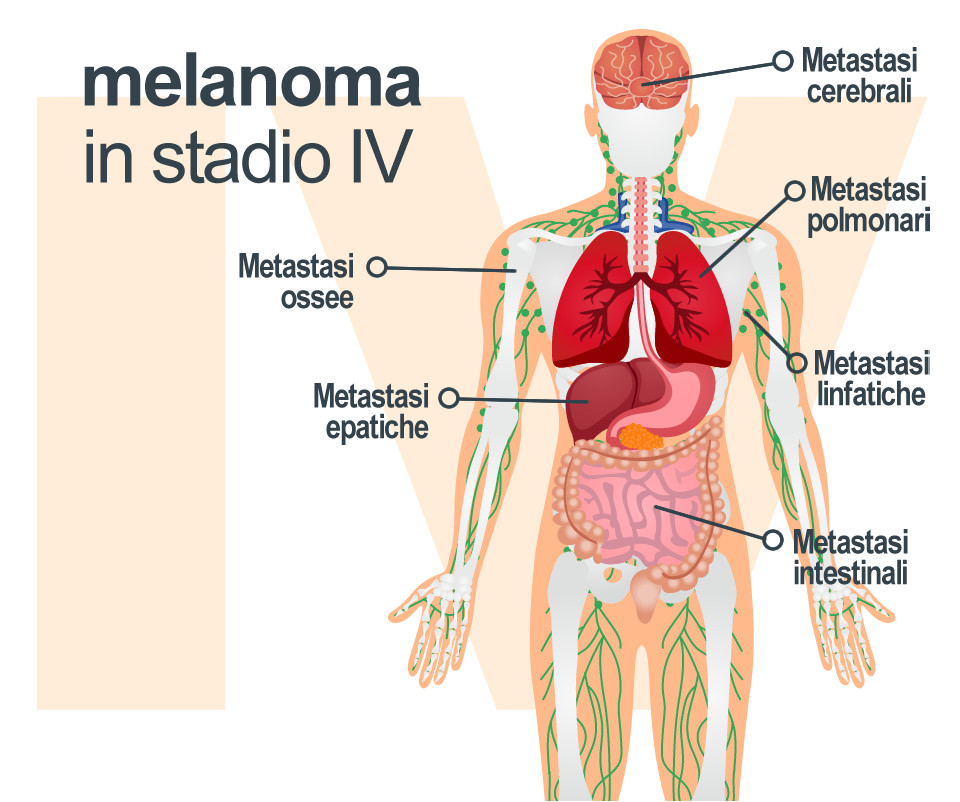 Evoluzione: Melanoma in stadio IV